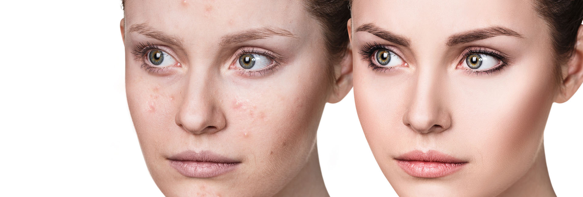 AKNE LIFT PEEL kezelés